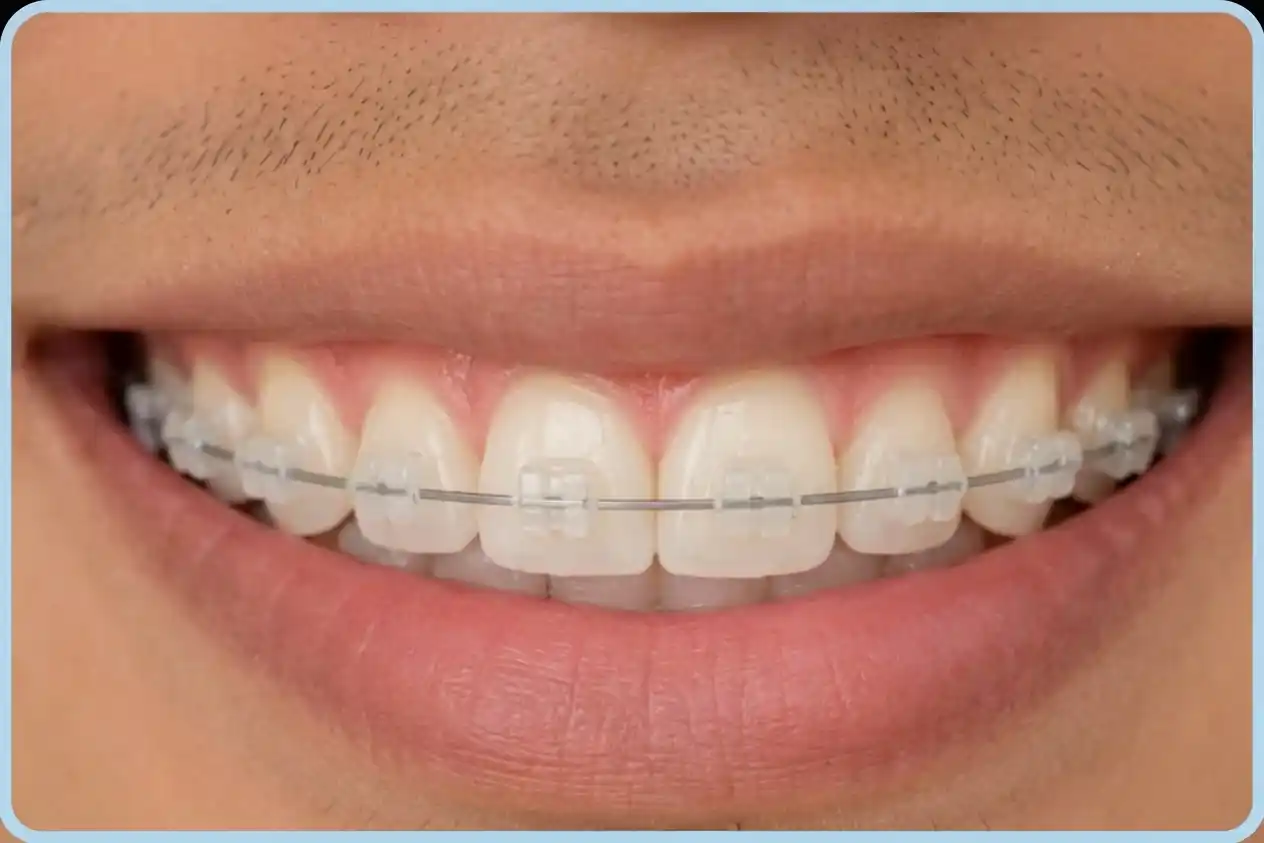 Ceramic braces treatment