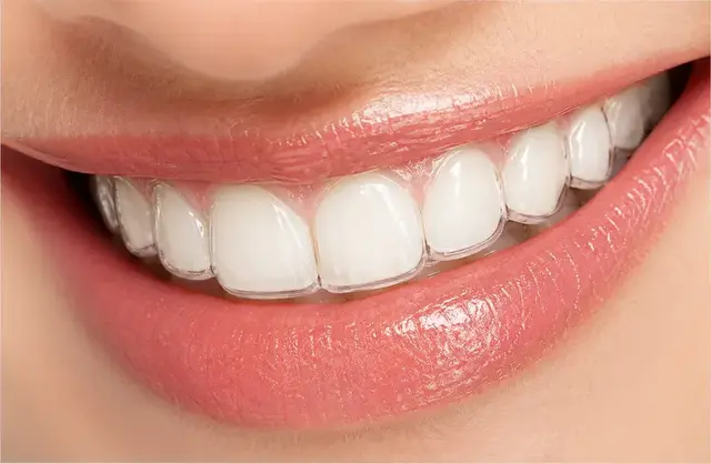 Clear aligners treatment